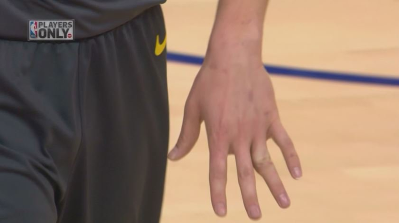 Illustration for article titled Klay Thompson's Finger Briefly Points In Surprising New Direction After Gross Injury